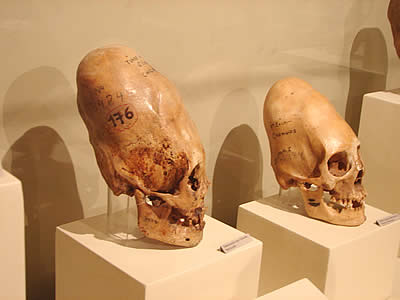 Paracas elongated skulls Peru red hair cranial deformation
